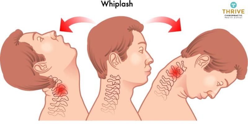 symptoms of whiplash include